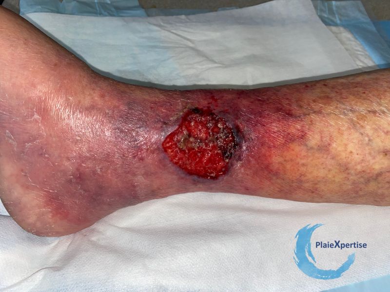 Fichier:Angiodermite typique97.jpg