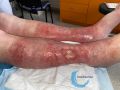 Eczéma108.jpg