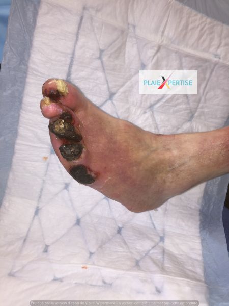 Fichier:Nécrose sèche Pied 9.jpg