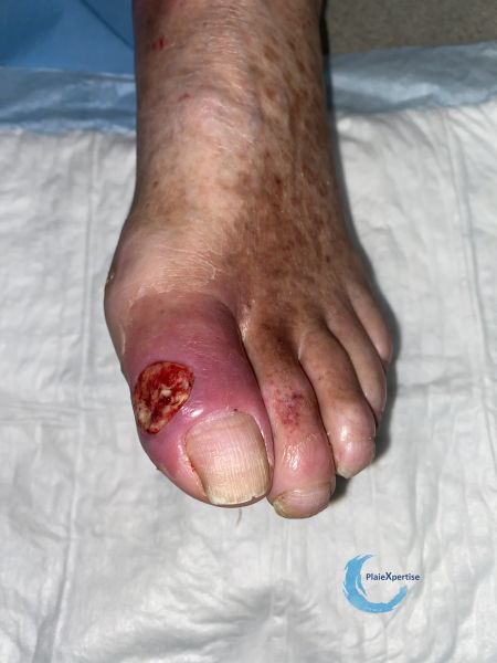 Fichier:Pied infecté35.jpg