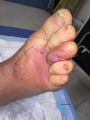 Pied infecté42.jpg