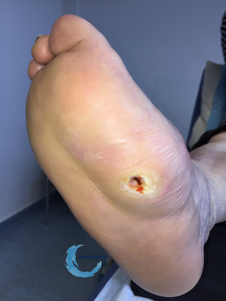Fichier:Pied de Charcot13.png