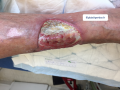 Tendon-Voussure4.png