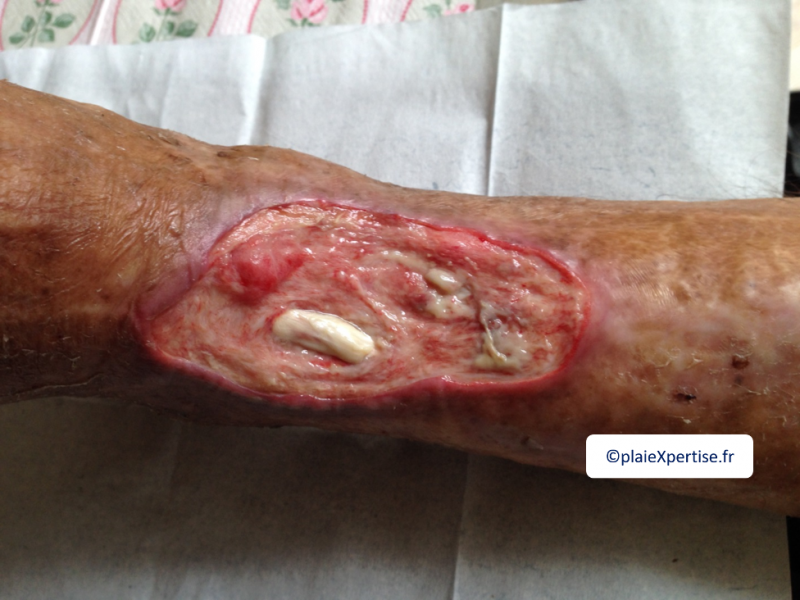 Fichier:Tendon normal4.png