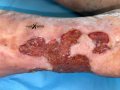 Tissu de granulation inflammatoire19.png