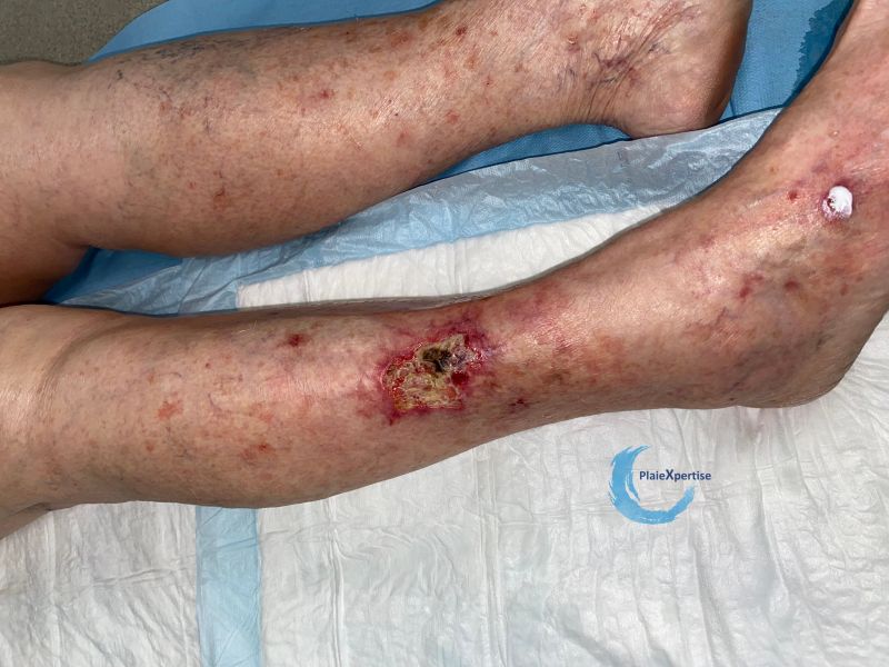 Fichier:Angiodermite atypique20.jpg
