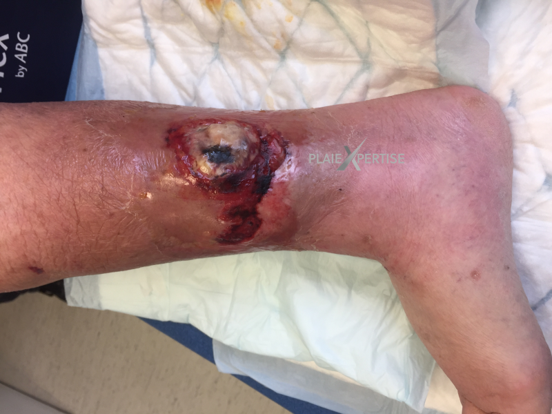 Fichier:Angiodermite typique24.png