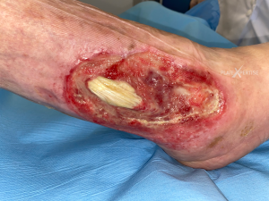 Tendon normal24.png
