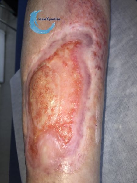 Fichier:Ulcère scléreux78.jpg