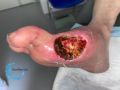 Amputation4.jpg