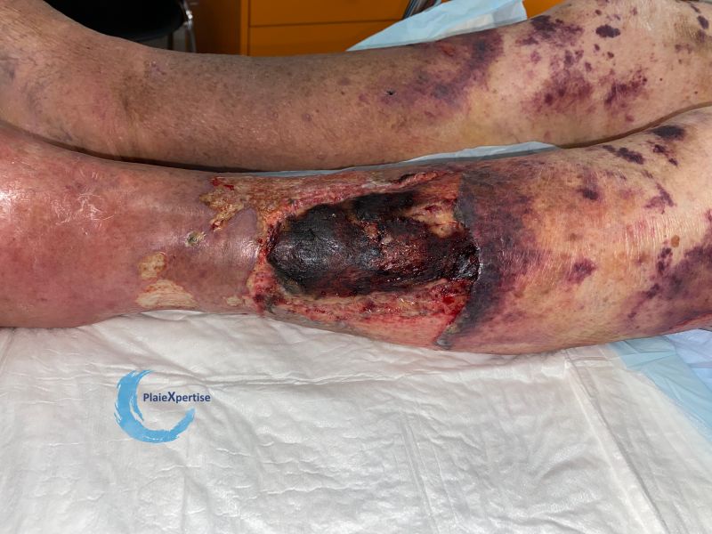 Fichier:Dermatoporose48.jpg