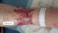 Purpura pustuleux1.png
