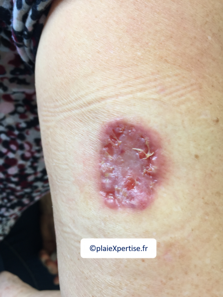 Fichier:Pyoderma gangrenosum14.png