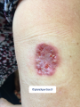 Pyoderma gangrenosum14.png