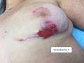 Pyoderma gangrenosum9.png