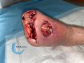 Amputation56.jpg