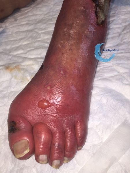 Fichier:Erythrocyanose7.jpg