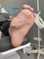 Pied de Charcot23.jpg