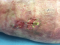 Epidermolyse bulleuse acquise4.png