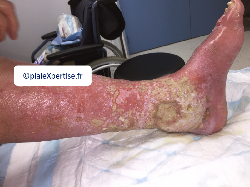Fichier:Grosses jambes suintantes2.png