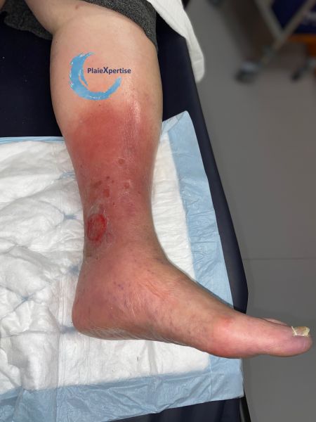 Fichier:Hypodermite chronique59.jpg
