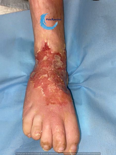 Fichier:Cou de pied106.jpg