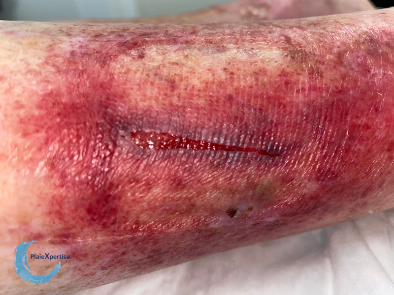Fichier:Dermatoporose31.png