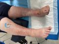 Hypodermite chronique71.jpg