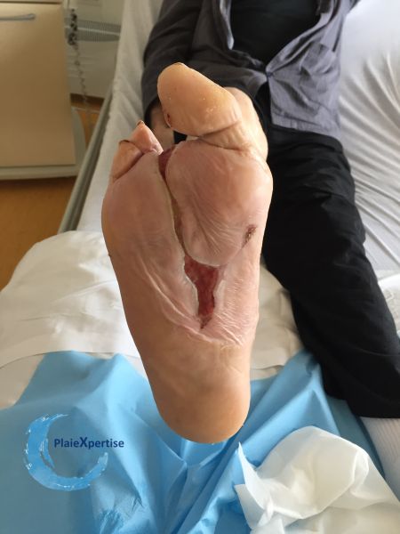 Fichier:Amputation40.jpg