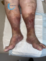 Dermiteocre56.png