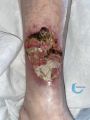 Angiodermite typique106.jpg