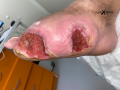 Pied de Charcot3.png