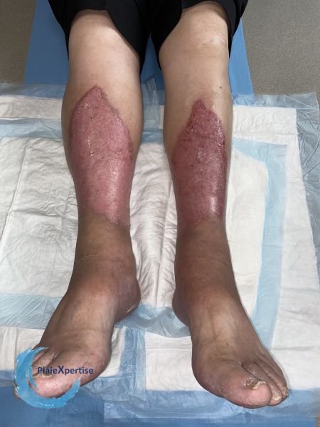 Fichier:Nécrobiose lipoïdique25.jpg