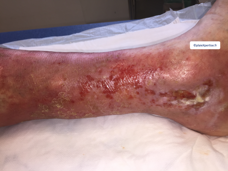 Fichier:Erosion ponctiforme moins de 5 mm1.png