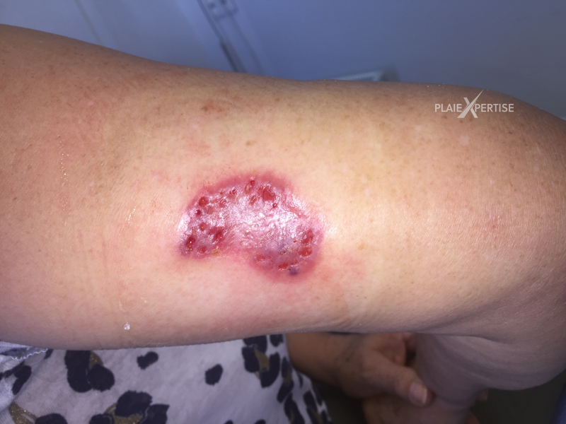 Fichier:Plaie cribiforme13.png