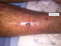 Pustules5.png