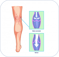 Varices.png