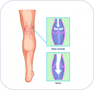 Varices.png