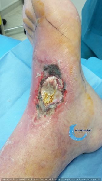 Fichier:Cou de pied105.jpg