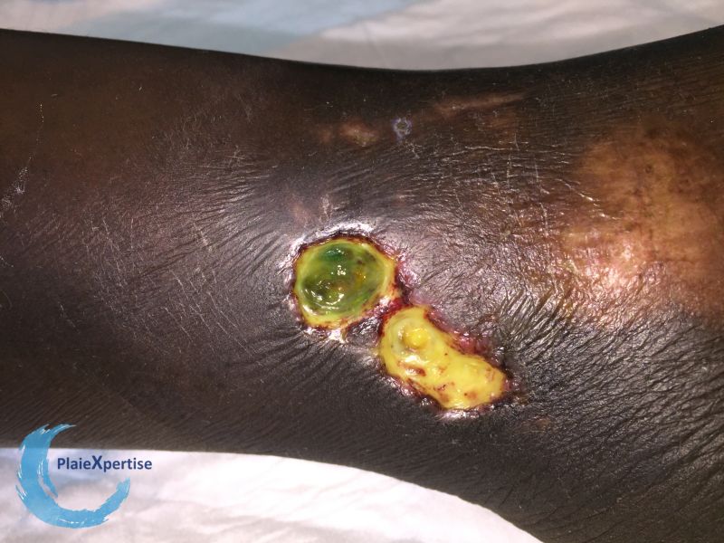 Fichier:Drépanocytose17.jpg