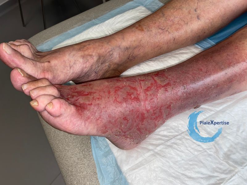 Fichier:Eczéma97.jpg