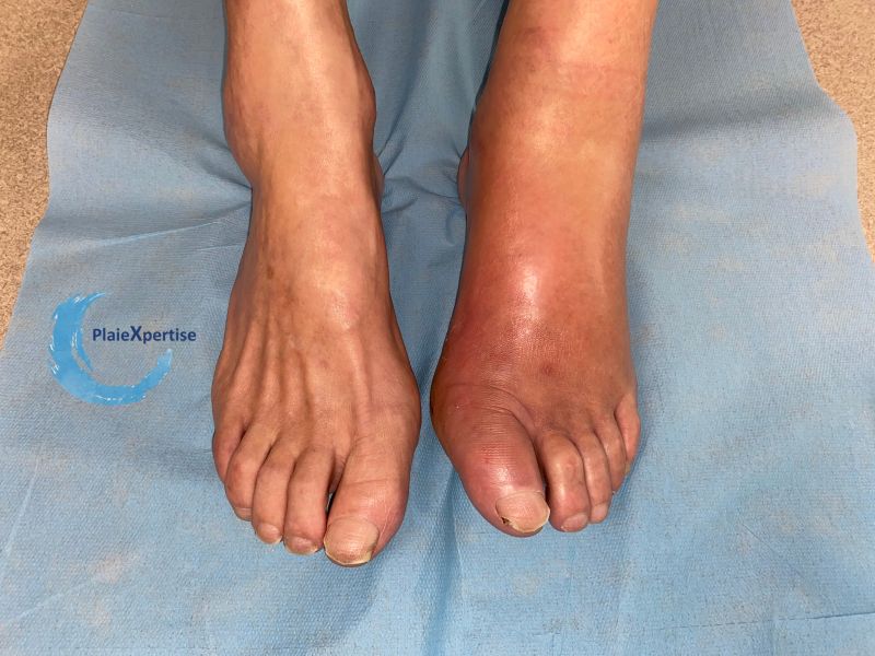 Fichier:Erythrocyanose13.jpg