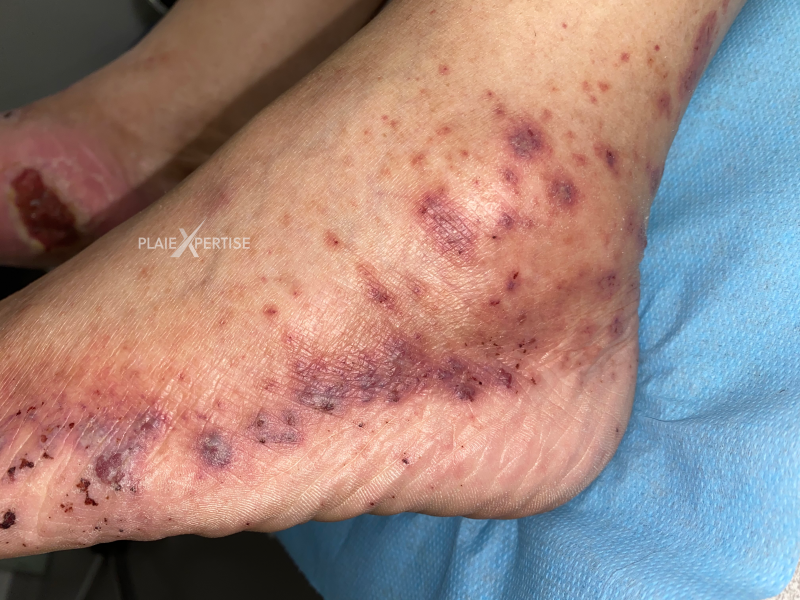 Fichier:Vascularite21.png