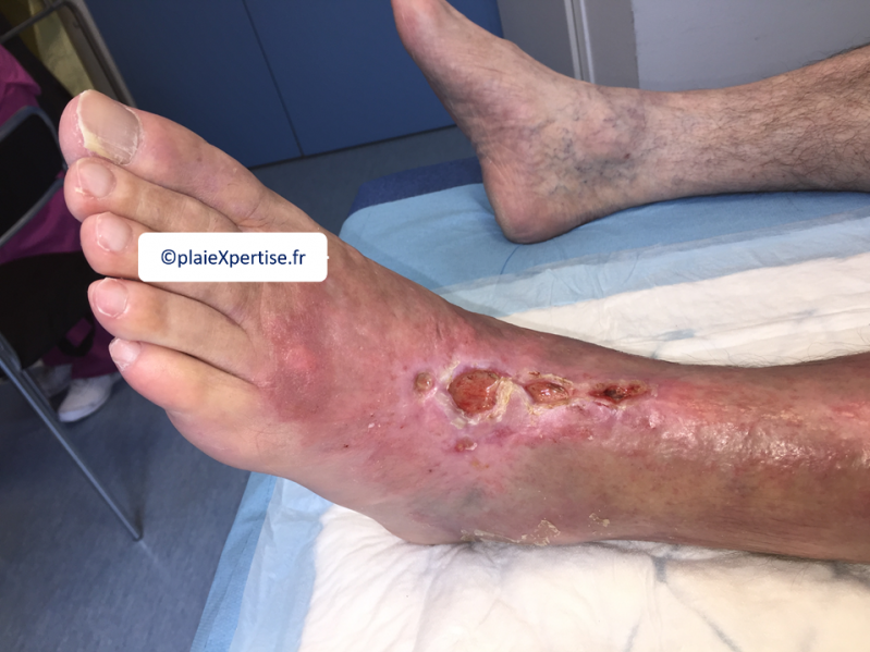 Fichier:Cou de pied6.png