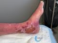 Dermite d'irritation108.jpg