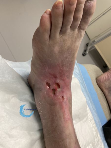 Fichier:Cou de pied81.jpg