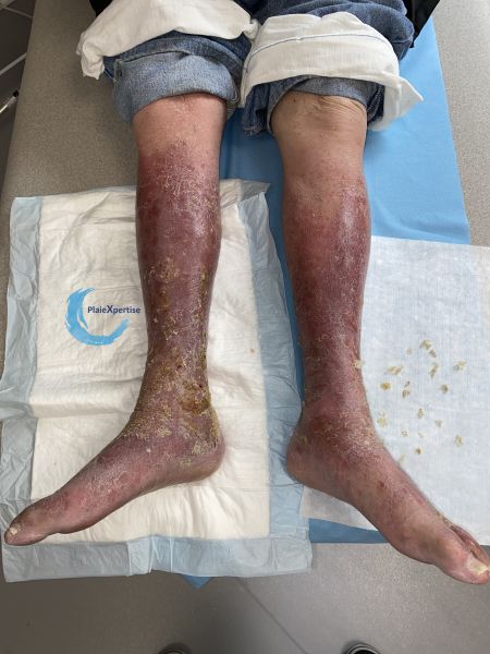 Fichier:Eczéma159.jpg