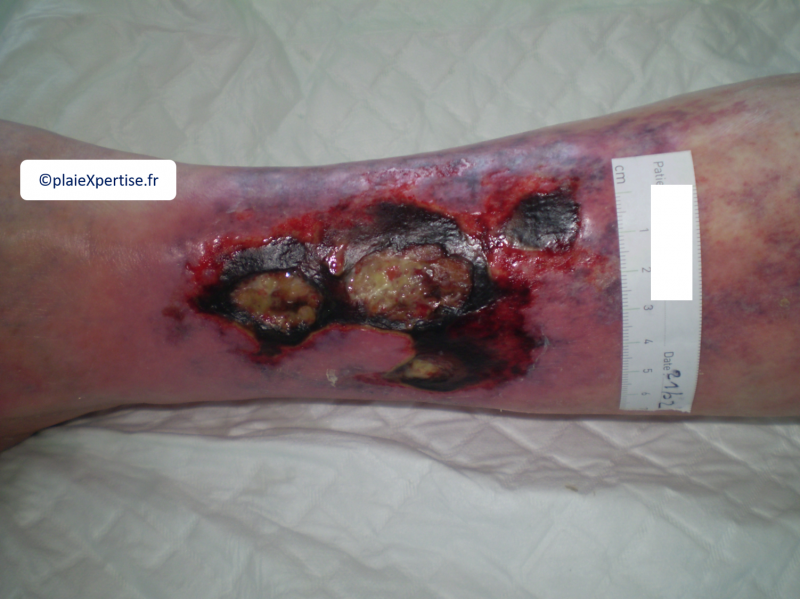 Fichier:Angiodermite typique15.png