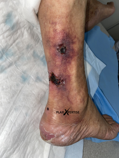Fichier:Angiodermite typique50.png