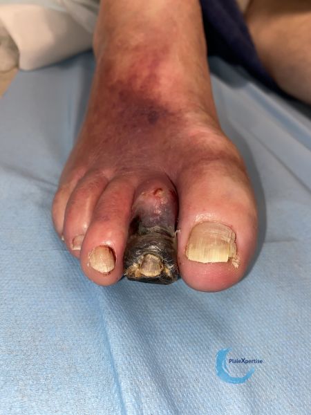 Fichier:Pied infecté10.jpg